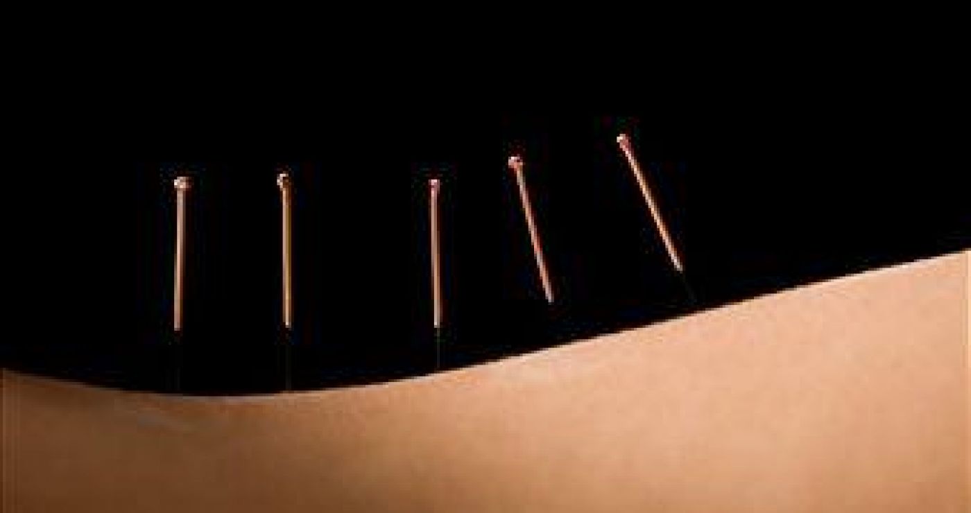 Dry needling